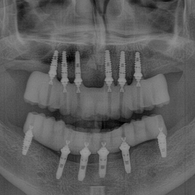 Dental X-Ray Photo